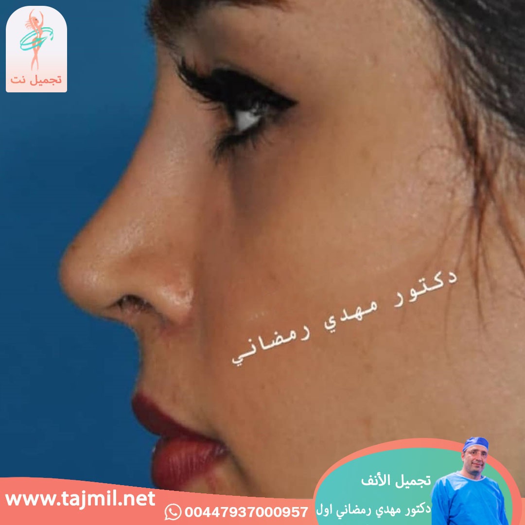  - دكتور مهدي رمضاني اول عملية تجميل الانف في ايران مع تجميل نت