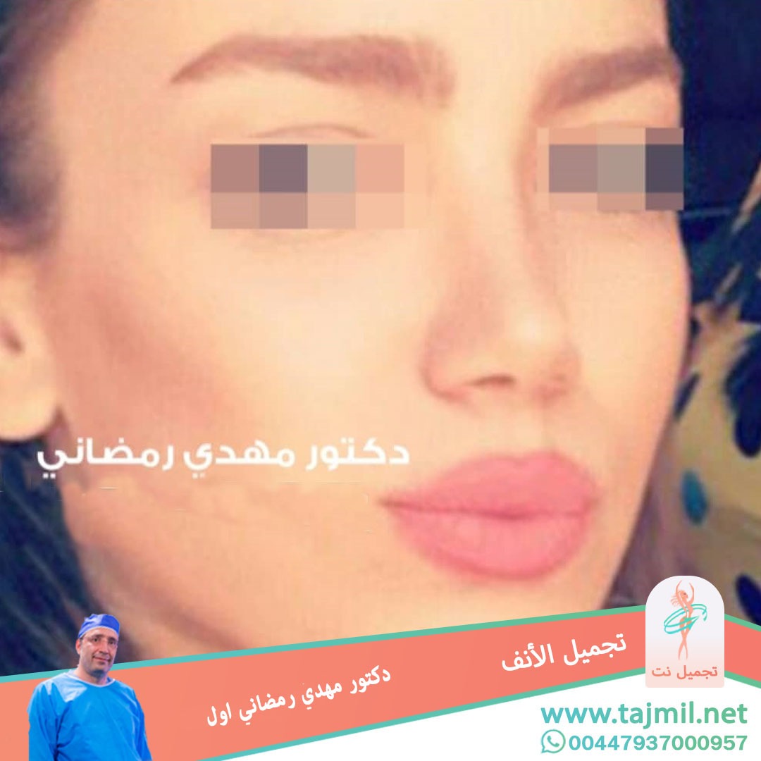  - دكتور مهدي رمضاني اول عملية تجميل الانف في ايران مع تجميل نت