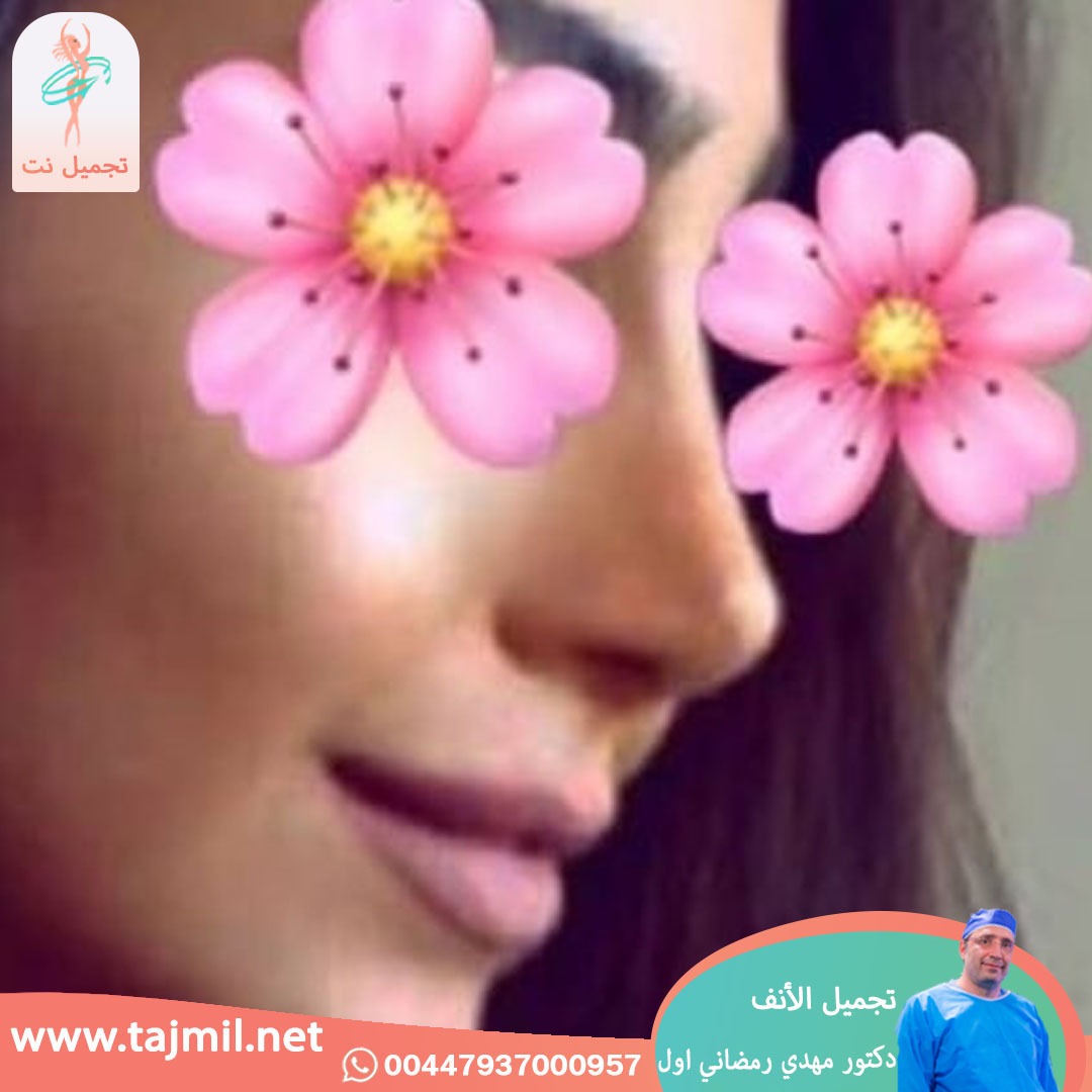  - دكتور مهدي رمضاني اول عملية تجميل الانف في ايران مع تجميل نت