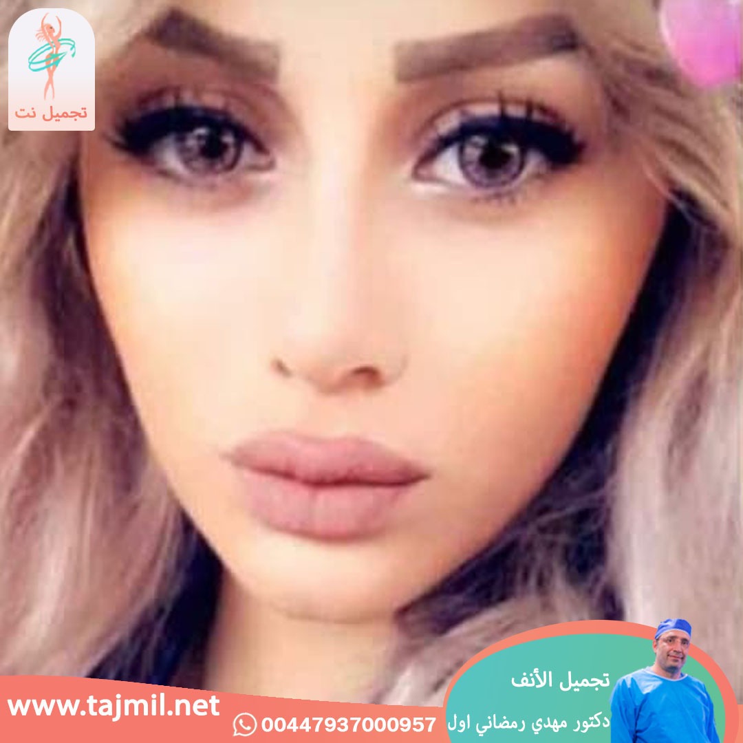  - دكتور مهدي رمضاني اول عملية تجميل الانف في ايران مع تجميل نت