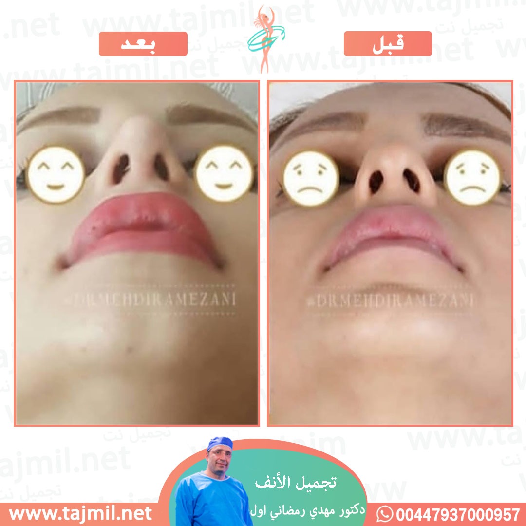  - دكتور مهدي رمضاني اول عملية تجميل الانف في ايران مع تجميل نت