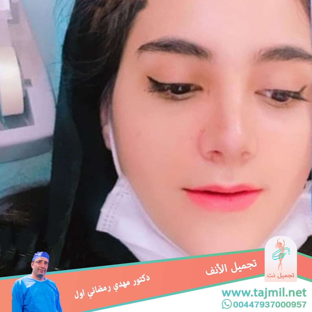  - دكتور مهدي رمضاني اول عملية تجميل الانف في ايران مع تجميل نت