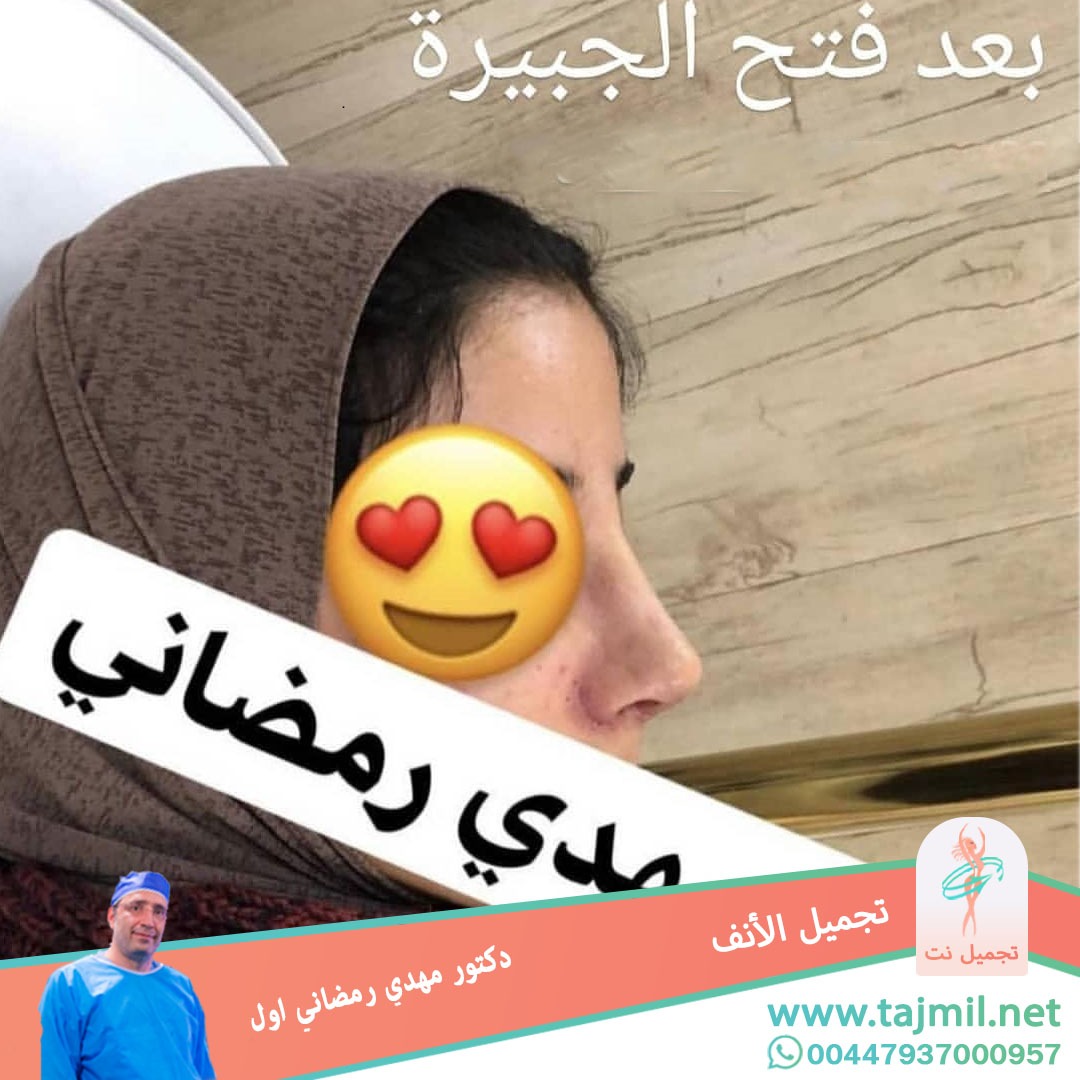  - دكتور مهدي رمضاني اول عملية تجميل الانف في ايران مع تجميل نت