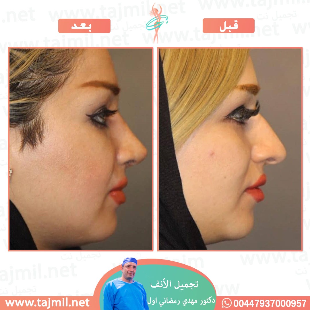  - دكتور مهدي رمضاني اول عملية تجميل الانف في ايران مع تجميل نت