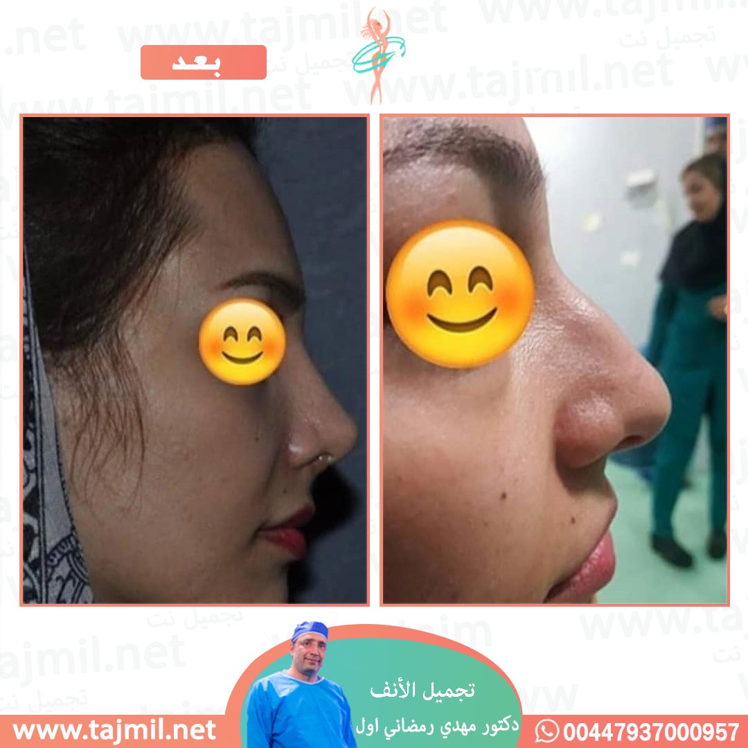  - دكتور مهدي رمضاني اول عملية تجميل الانف في ايران مع تجميل نت