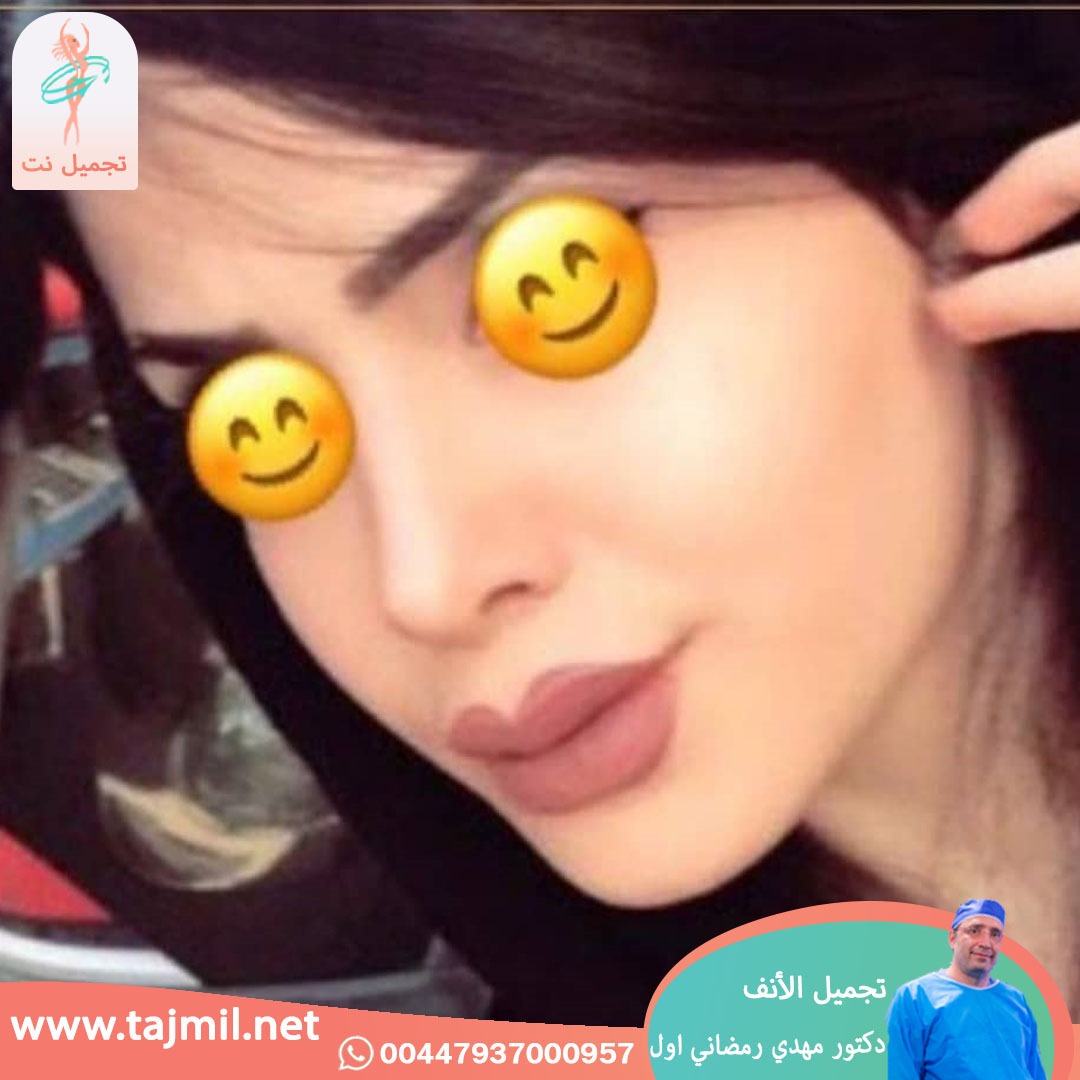  - دكتور مهدي رمضاني اول عملية تجميل الانف في ايران مع تجميل نت