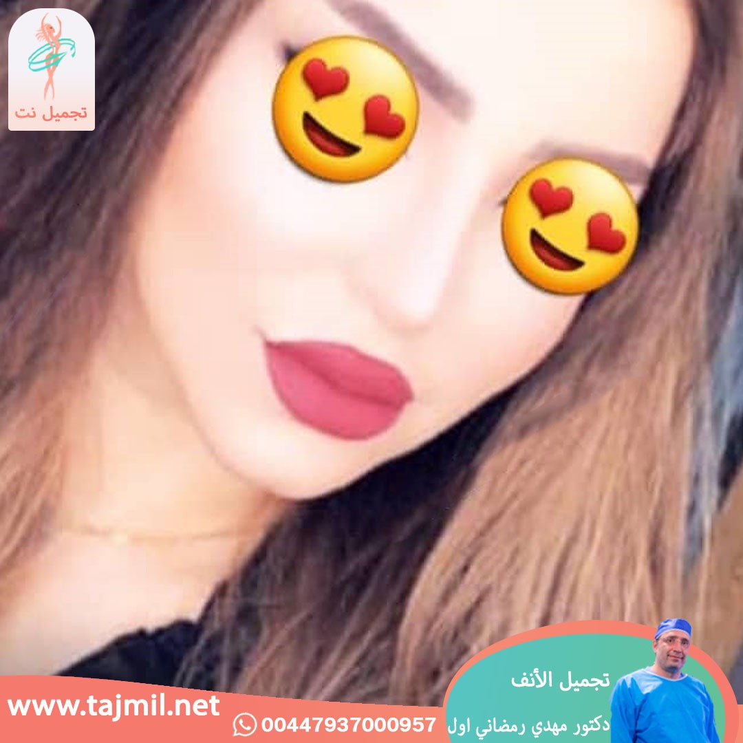  - دكتور مهدي رمضاني اول عملية تجميل الانف في ايران مع تجميل نت