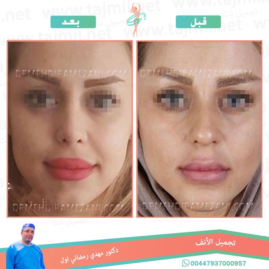  - دكتور مهدي رمضاني اول عملية تجميل الانف في ايران مع تجميل نت