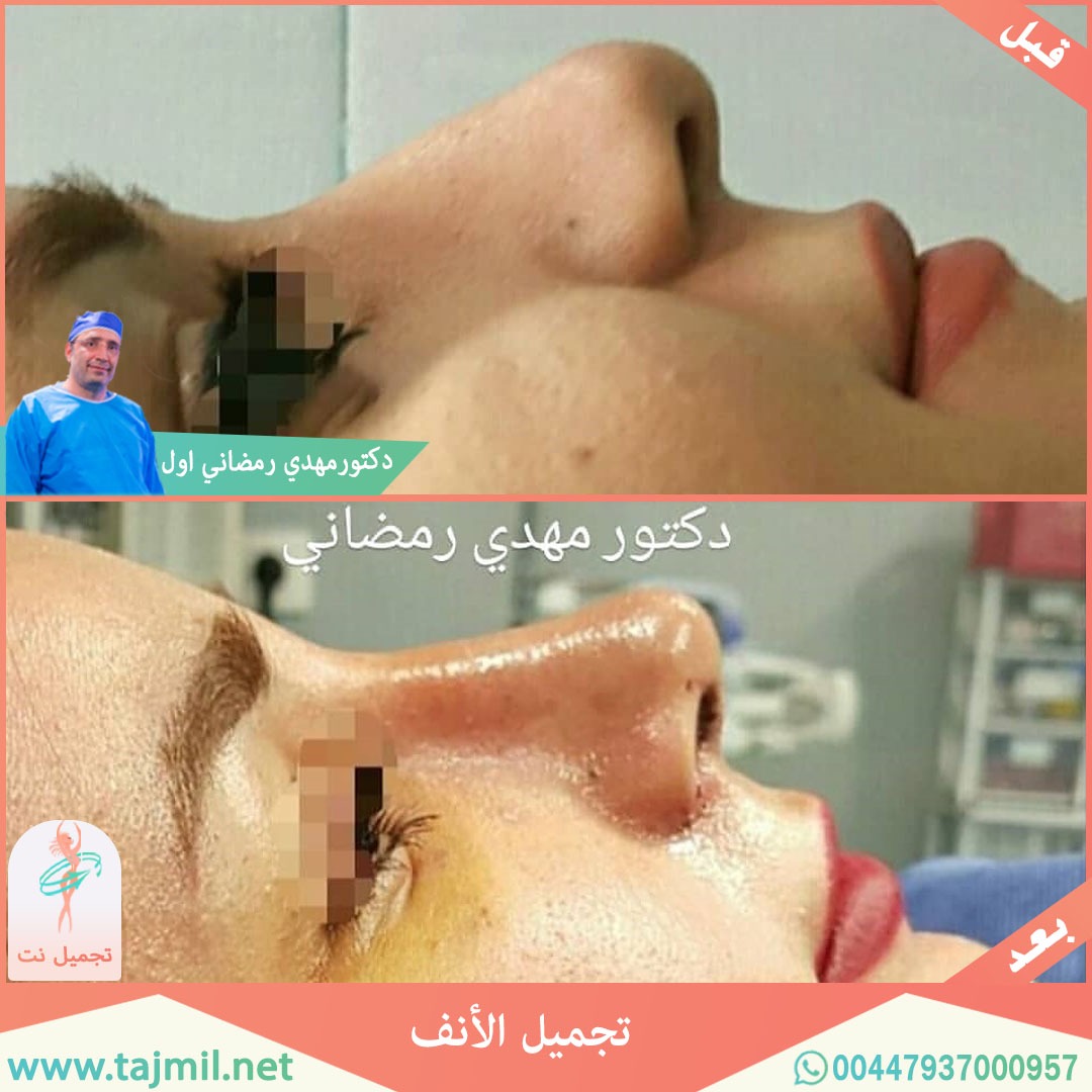  - دكتور مهدي رمضاني اول عملية تجميل الانف في ايران مع تجميل نت