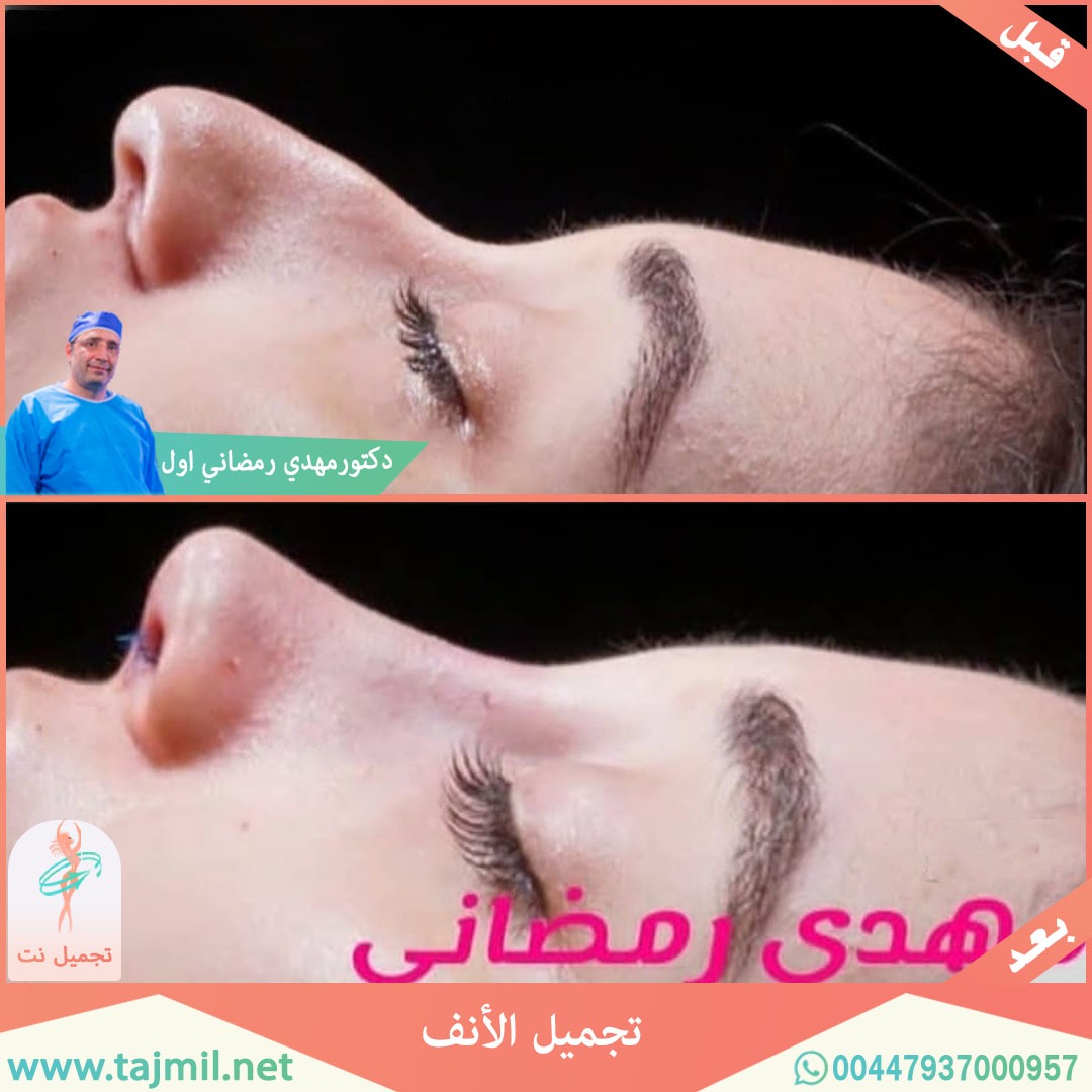  - دكتور مهدي رمضاني اول عملية تجميل الانف في ايران مع تجميل نت