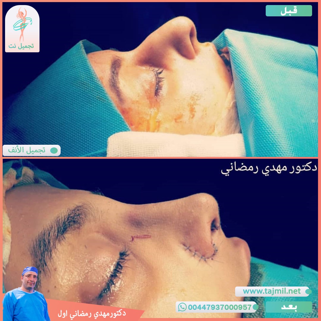  - دكتور مهدي رمضاني اول عملية تجميل الانف في ايران مع تجميل نت