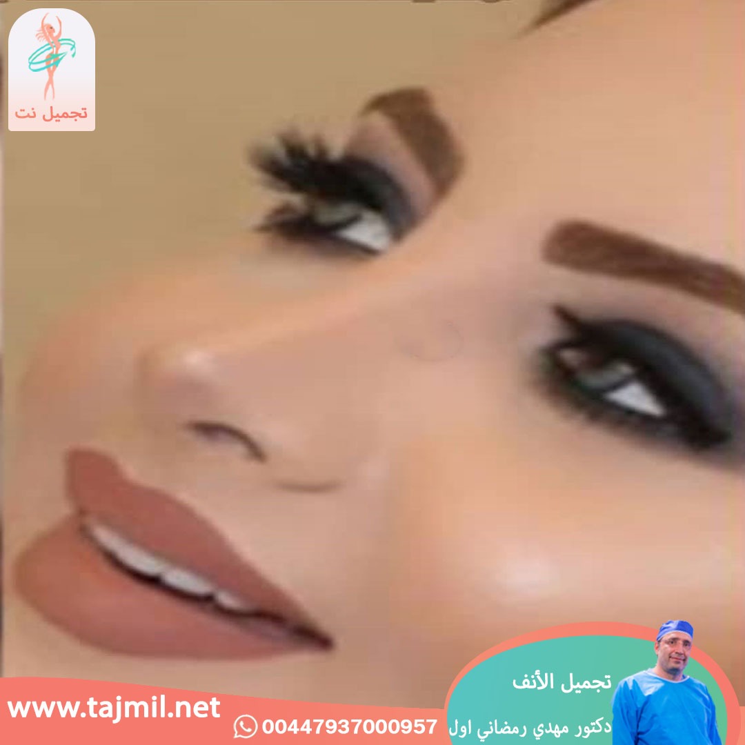  - دكتور مهدي رمضاني اول عملية تجميل الانف في ايران مع تجميل نت