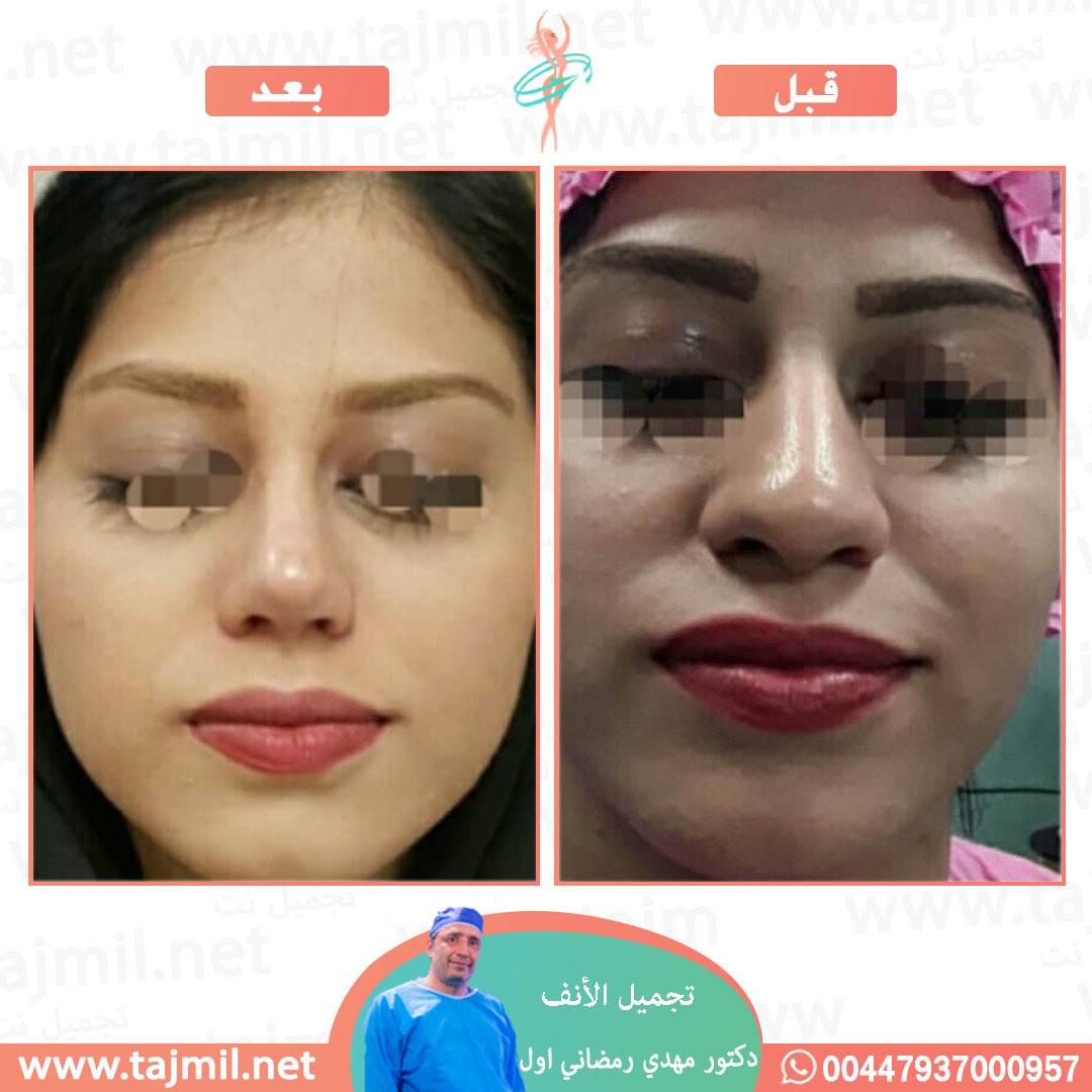  - دكتور مهدي رمضاني اول عملية تجميل الانف في ايران مع تجميل نت