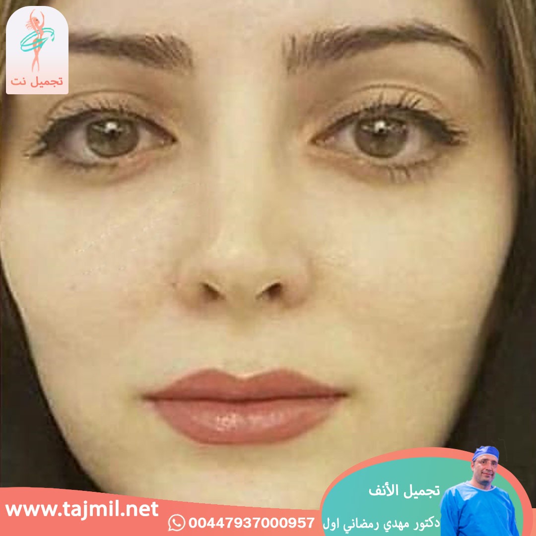  - دكتور مهدي رمضاني اول عملية تجميل الانف في ايران مع تجميل نت