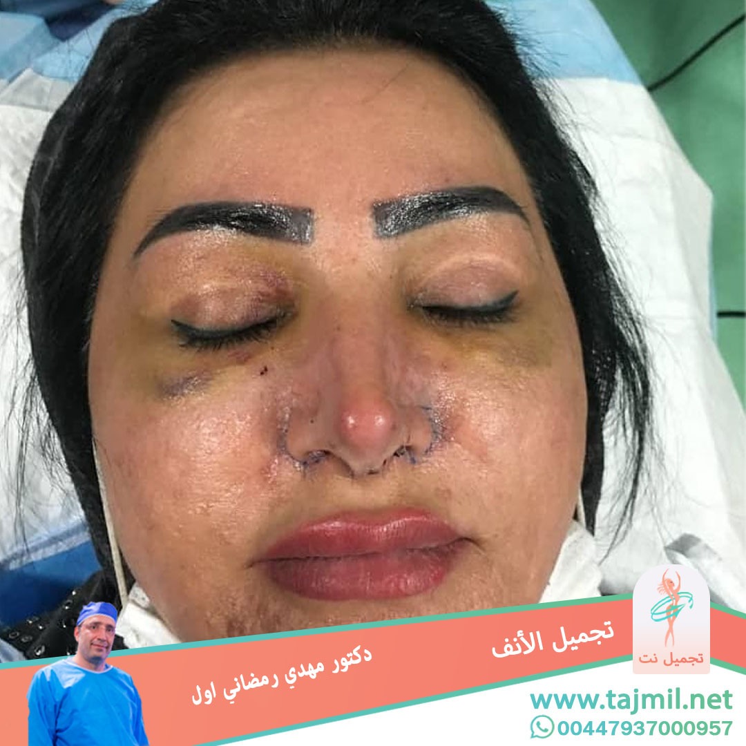  - دكتور مهدي رمضاني اول عملية تجميل الانف في ايران مع تجميل نت