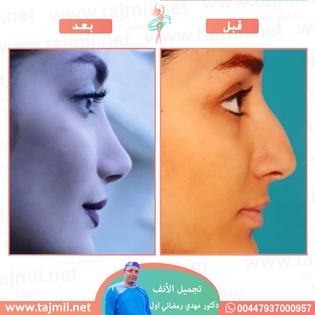  - دكتور مهدي رمضاني اول عملية تجميل الانف في ايران مع تجميل نت