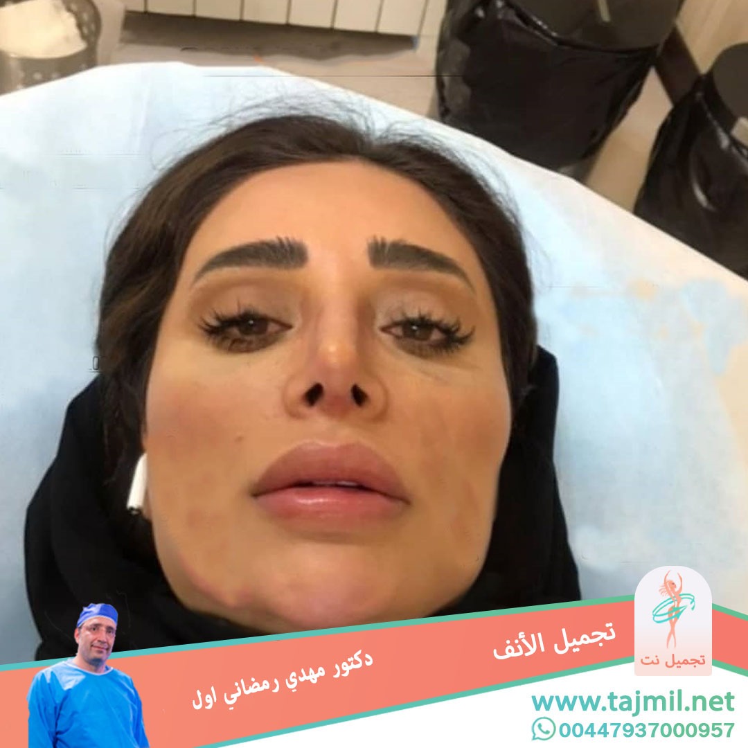  - دكتور مهدي رمضاني اول عملية تجميل الانف في ايران مع تجميل نت