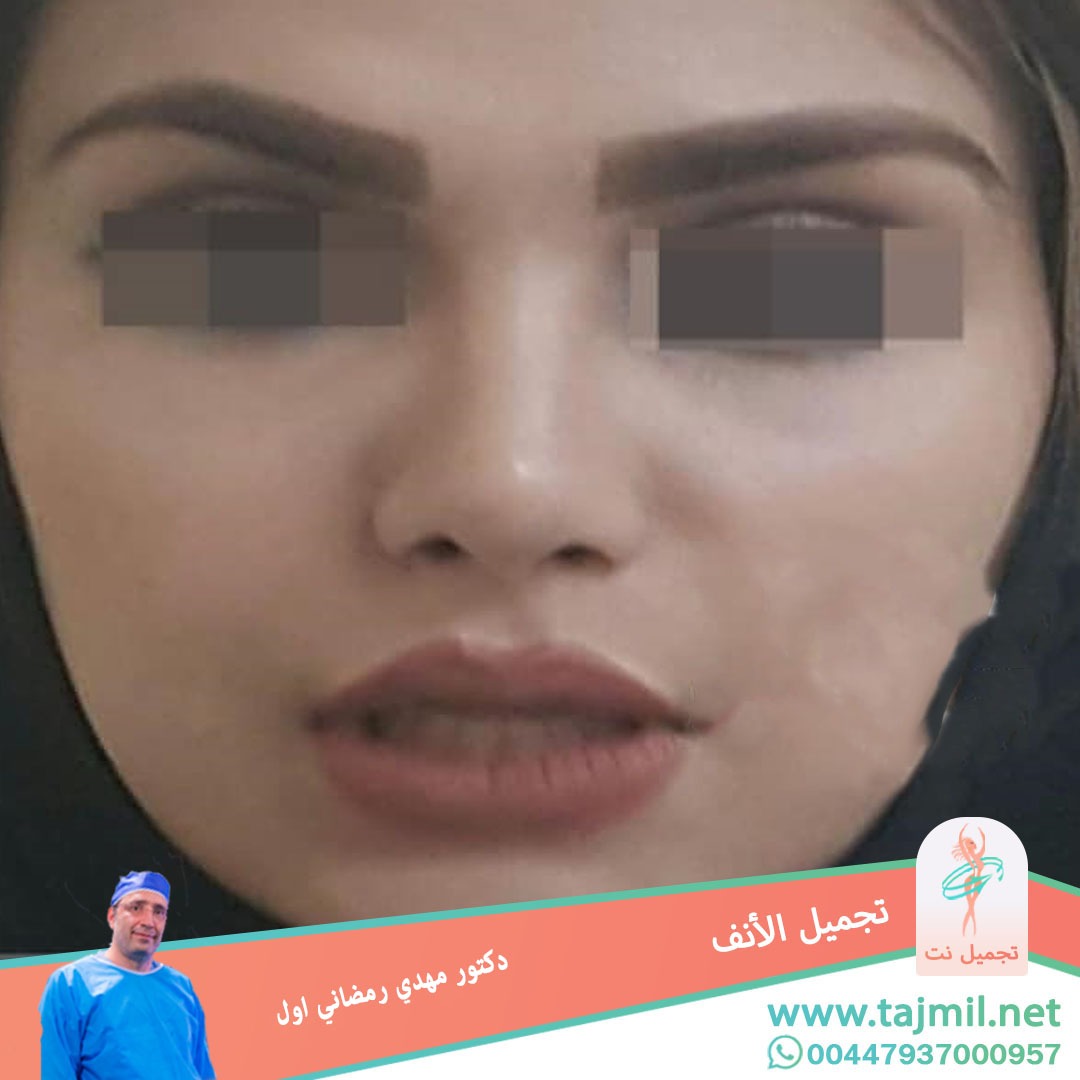  - دكتور مهدي رمضاني اول عملية تجميل الانف في ايران مع تجميل نت