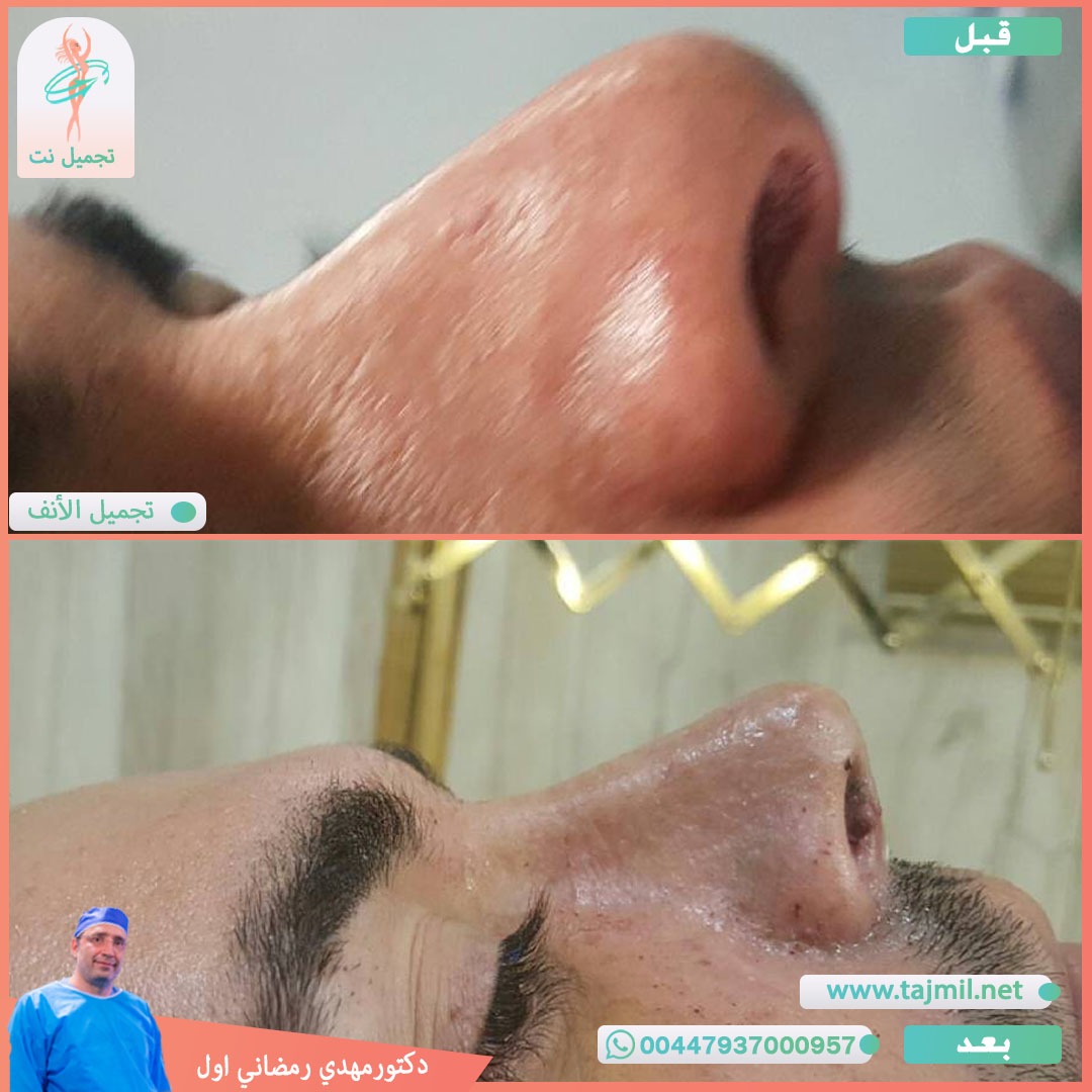  - دكتور مهدي رمضاني اول عملية تجميل الانف في ايران مع تجميل نت