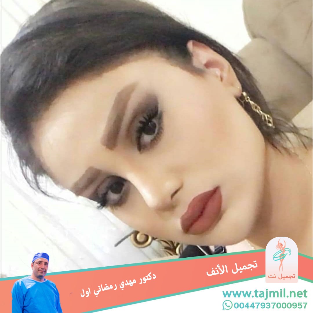  - دكتور مهدي رمضاني اول عملية تجميل الانف في ايران مع تجميل نت