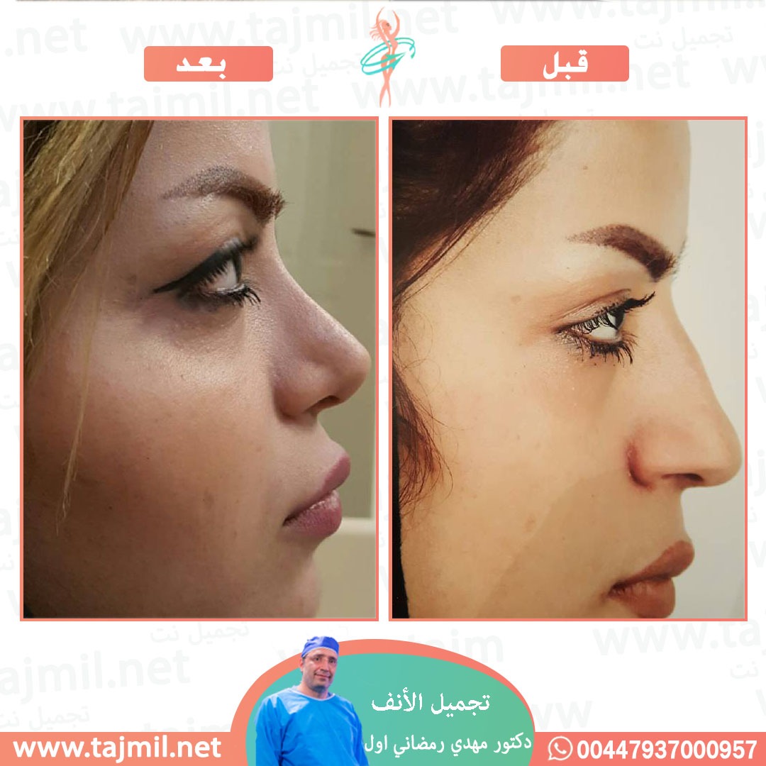  - دكتور مهدي رمضاني اول عملية تجميل الانف في ايران مع تجميل نت