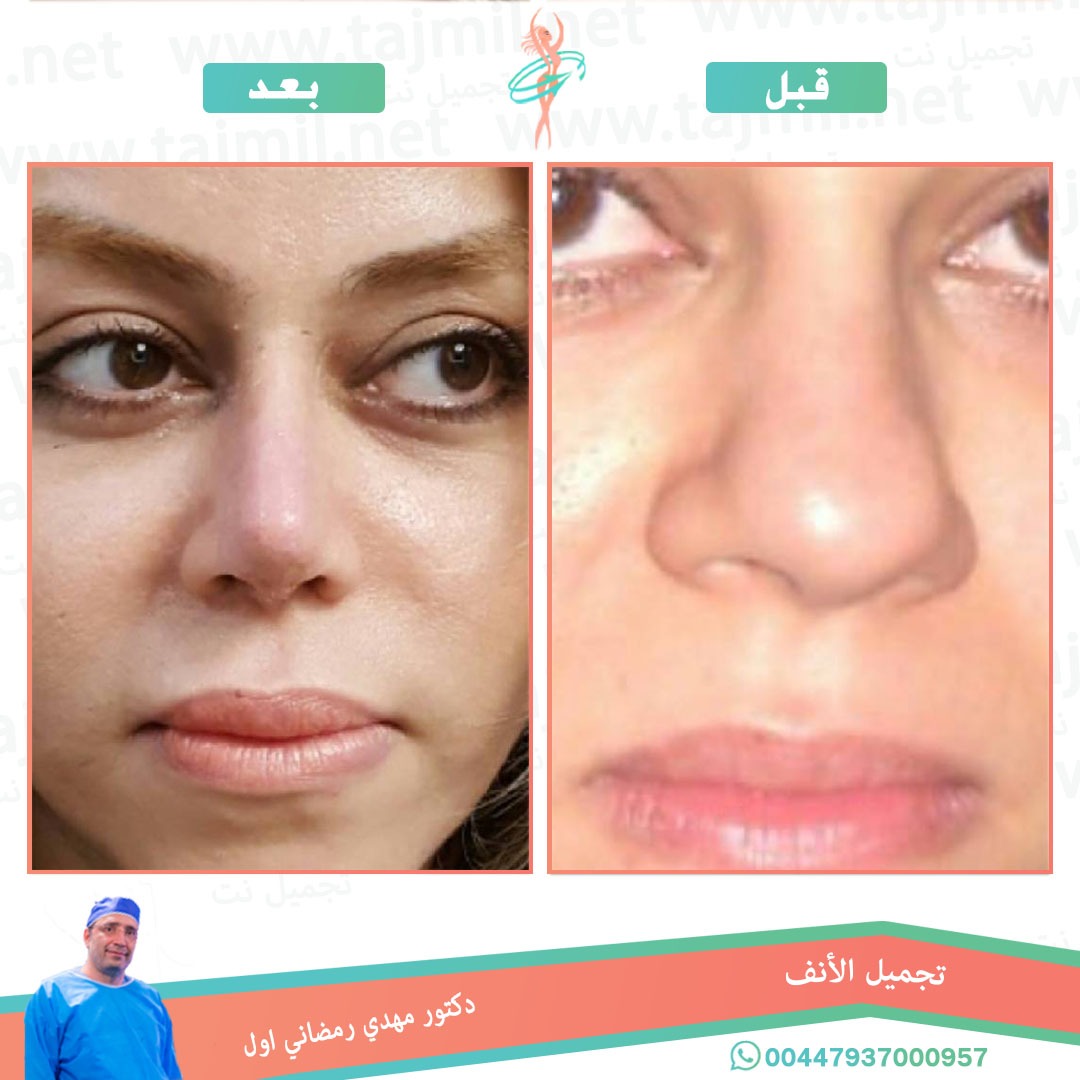  - دكتور مهدي رمضاني اول عملية تجميل الانف في ايران مع تجميل نت