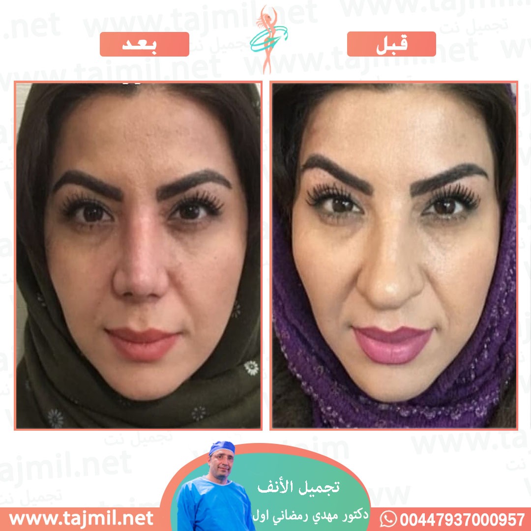  - دكتور مهدي رمضاني اول عملية تجميل الانف في ايران مع تجميل نت