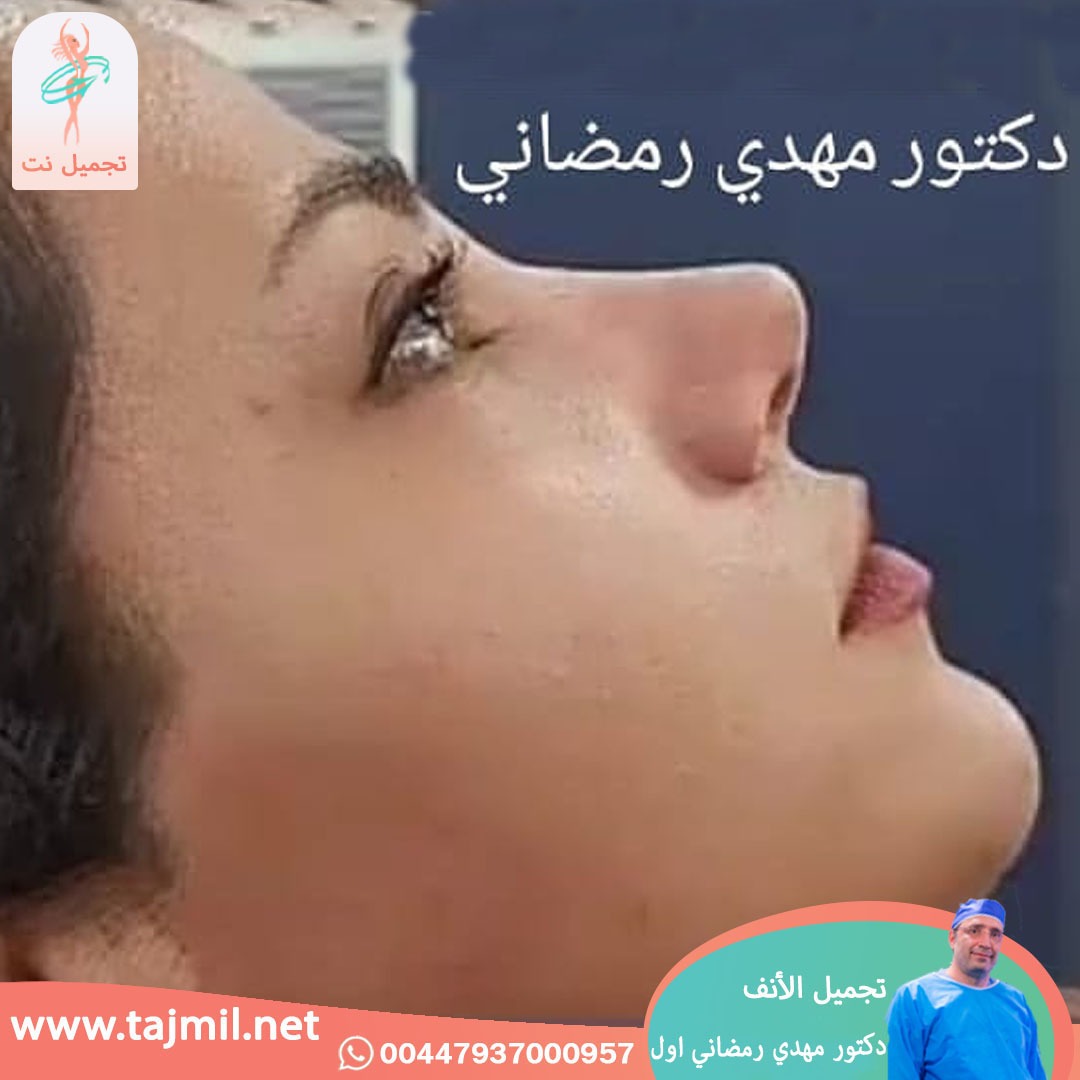  - دكتور مهدي رمضاني اول عملية تجميل الانف في ايران مع تجميل نت