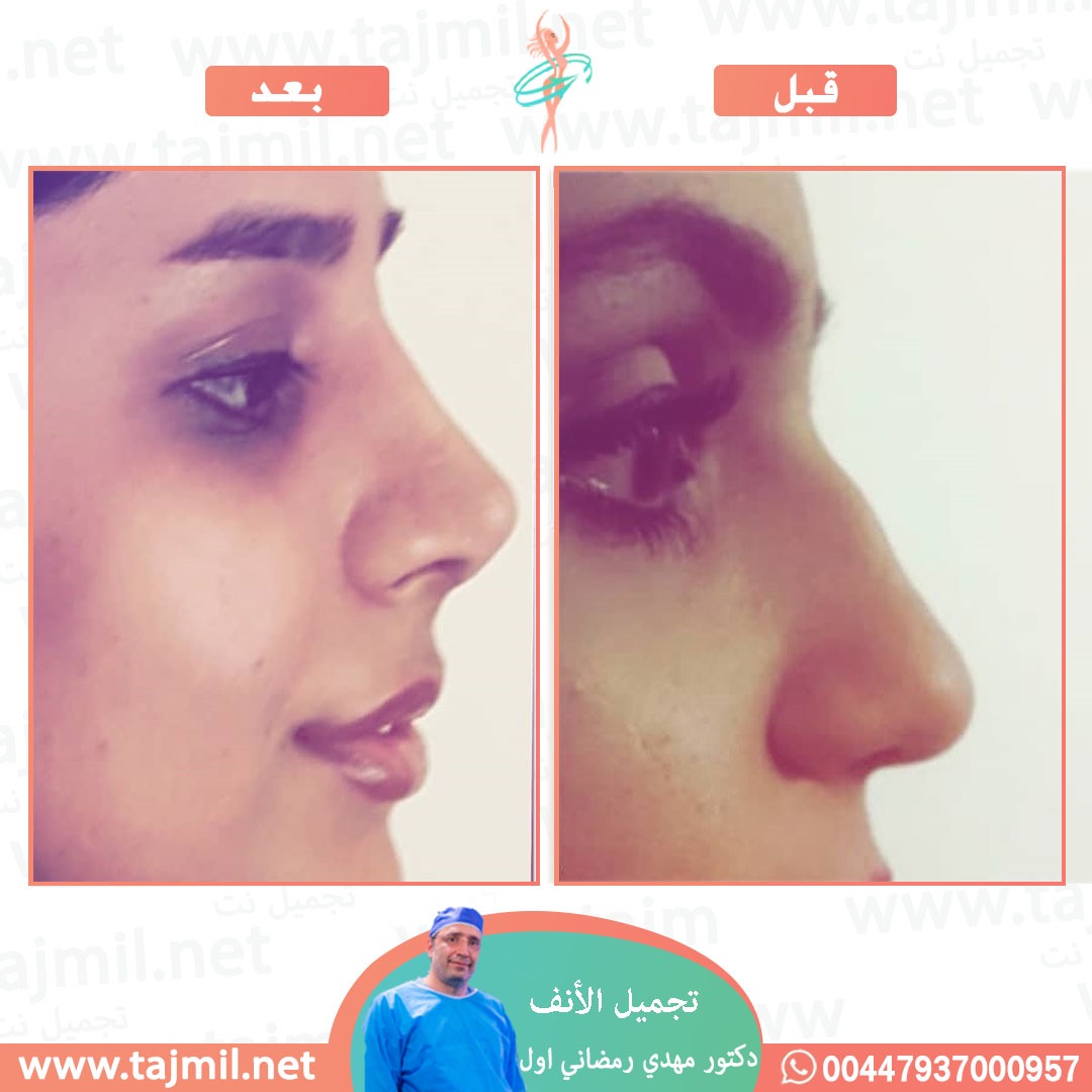  - دكتور مهدي رمضاني اول عملية تجميل الانف في ايران مع تجميل نت