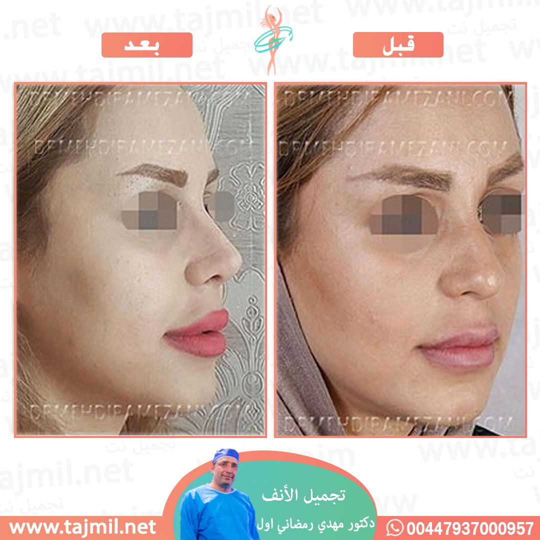  - دكتور مهدي رمضاني اول عملية تجميل الانف في ايران مع تجميل نت