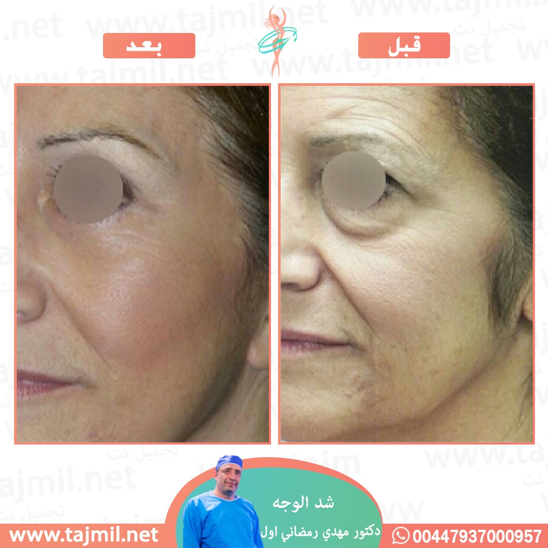  - دكتور مهدي رمضاني اول عملية شد الوجه في ايران مع تجميل نت