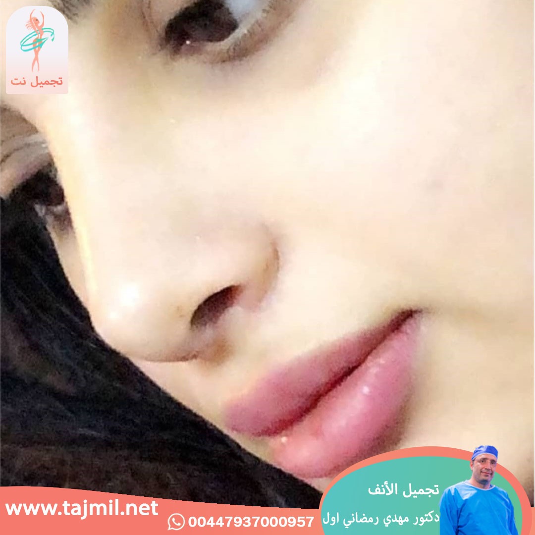  - دكتور مهدي رمضاني اول عملية تجميل الانف في ايران مع تجميل نت