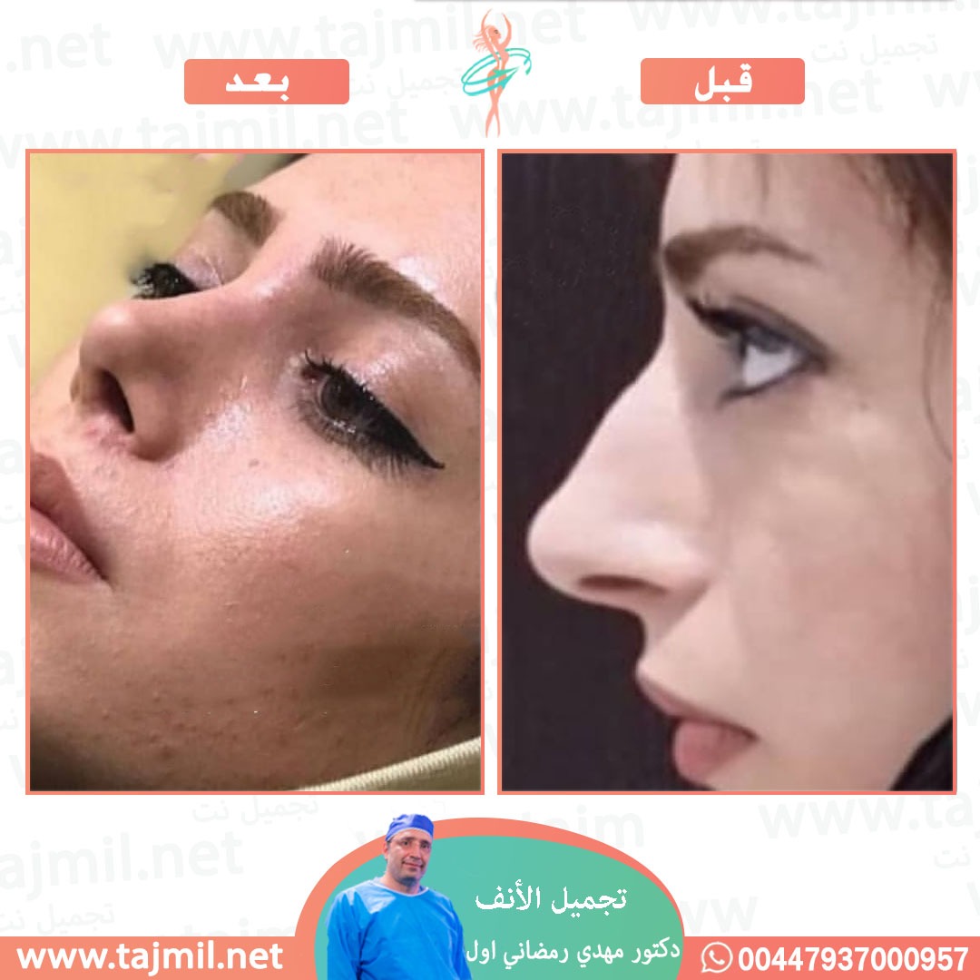  - دكتور مهدي رمضاني اول عملية تجميل الانف في ايران مع تجميل نت