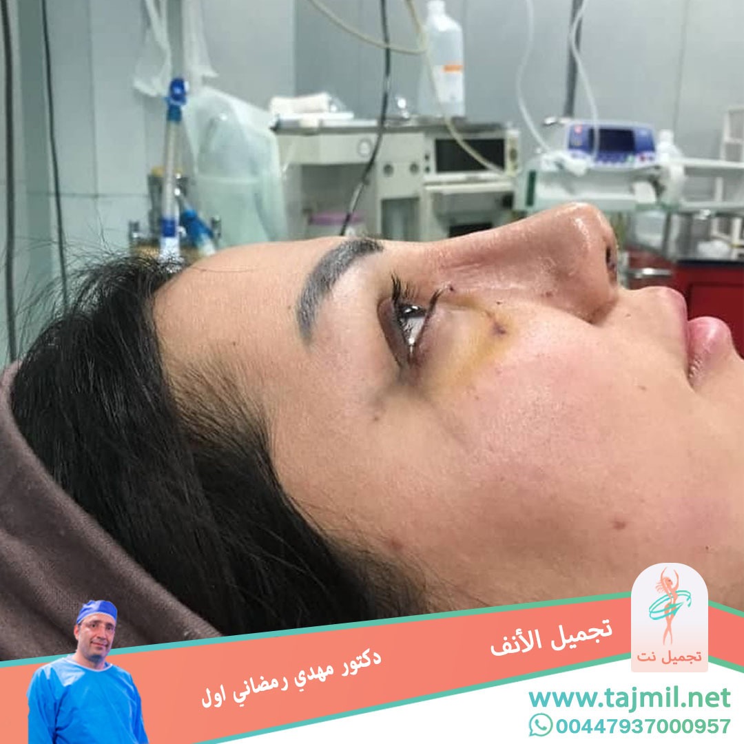  - دكتور مهدي رمضاني اول عملية تجميل الانف في ايران مع تجميل نت