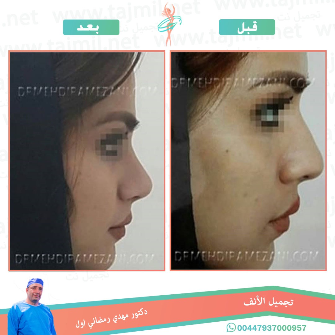  - دكتور مهدي رمضاني اول عملية تجميل الانف في ايران مع تجميل نت