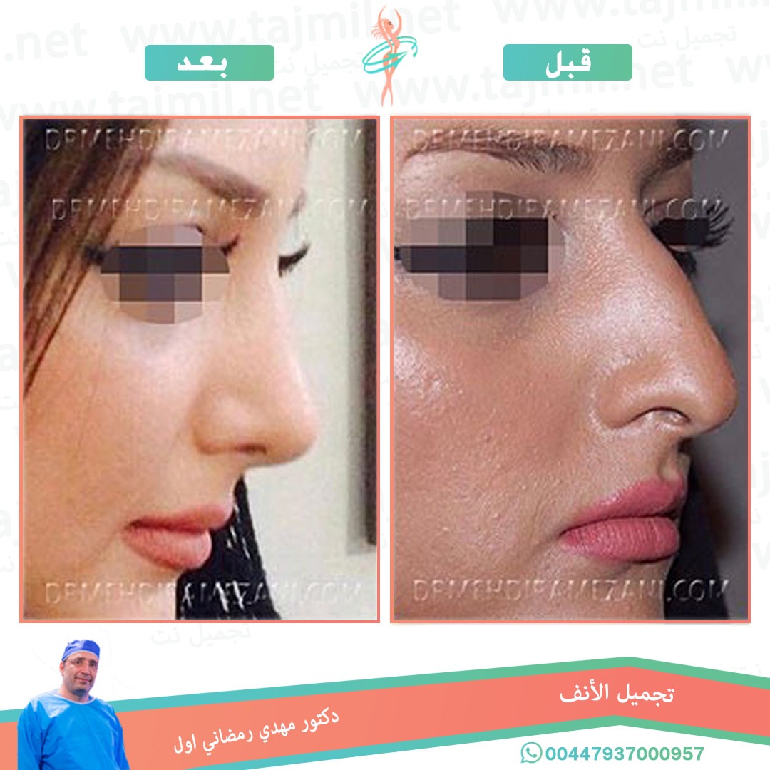  - دكتور مهدي رمضاني اول عملية تجميل الانف في ايران مع تجميل نت