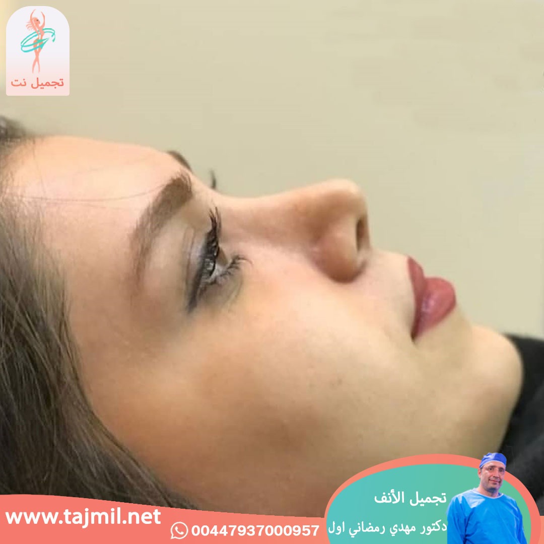  - دكتور مهدي رمضاني اول عملية تجميل الانف في ايران مع تجميل نت