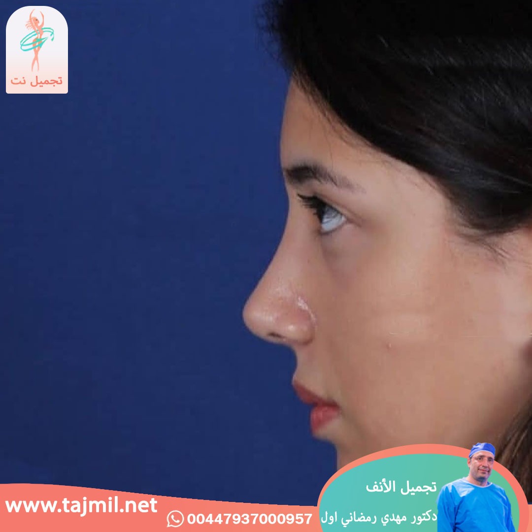  - دكتور مهدي رمضاني اول عملية تجميل الانف في ايران مع تجميل نت