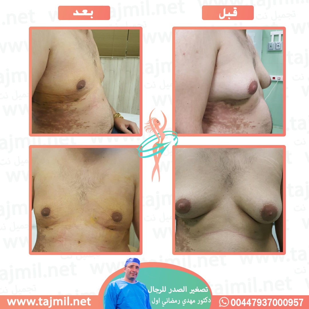  - دكتور مهدي رمضاني اول عملية تصغیر الصدر للرجال في ايران مع تجميل نت