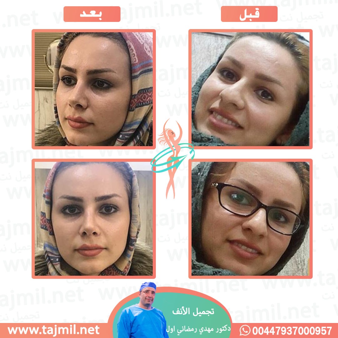  - دكتور مهدي رمضاني اول عملية تجميل الانف في ايران مع تجميل نت