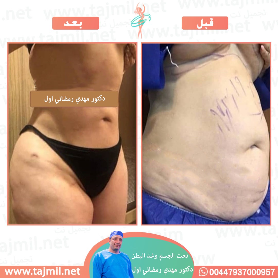  - دكتور مهدي رمضاني اول عملية نحت الجسم و شد البطن في ايران مع تجميل نت