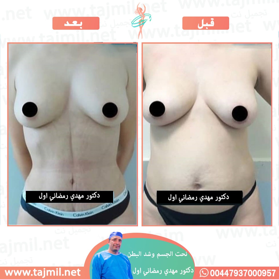  - دكتور مهدي رمضاني اول عملية نحت الجسم و شد البطن في ايران مع تجميل نت