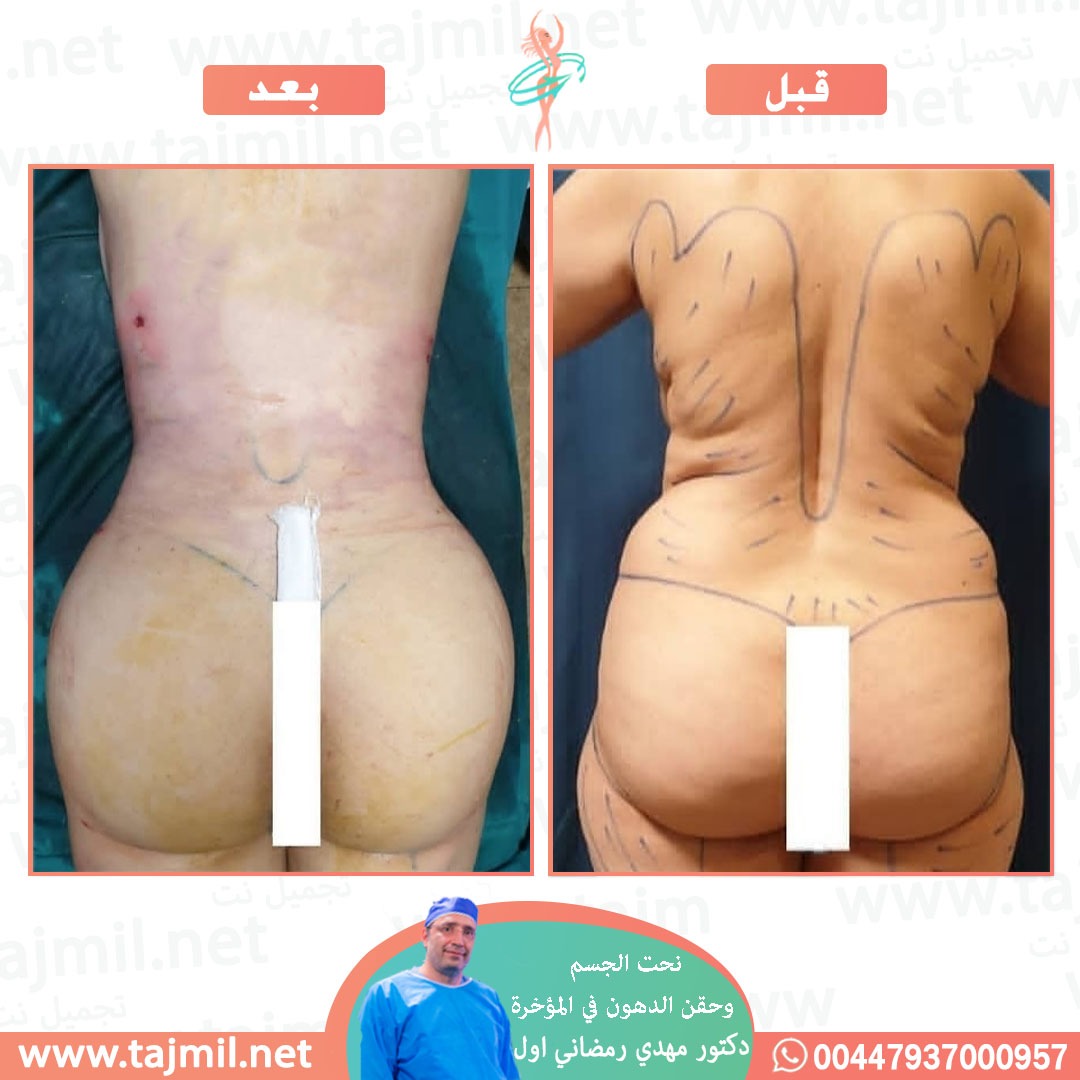  - دکتور إحسان خدیوي عملية نحت الجسم و حقن الدهون في المؤخرة في ايران مع تجميل نت