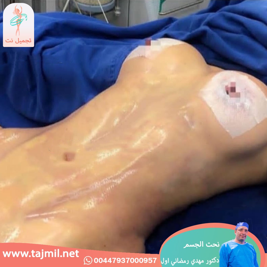  - دكتور مهدي رمضاني اول عملية نحت الجسم في ايران مع تجميل نت