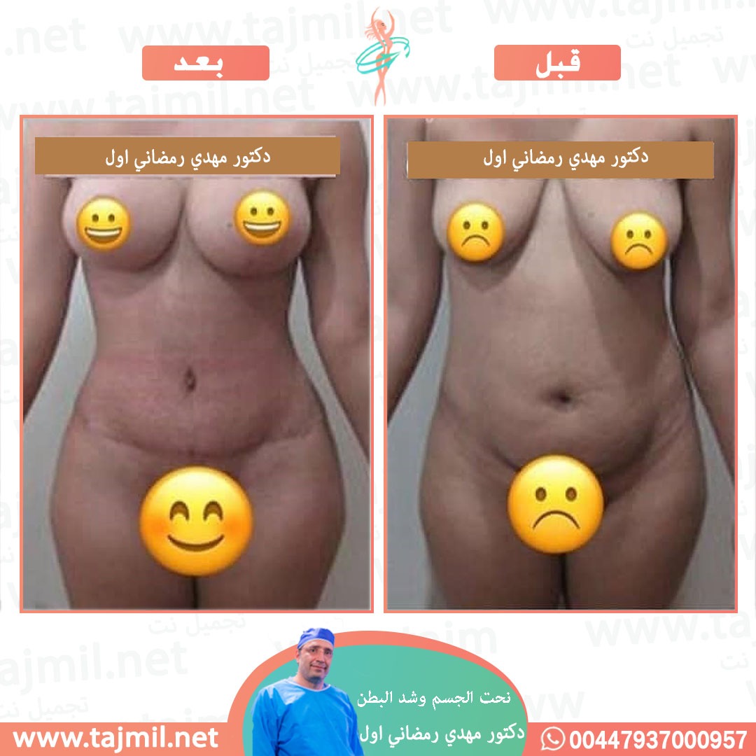  - دكتور مهدي رمضاني اول عملية نحت الجسم و شد البطن في ايران مع تجميل نت