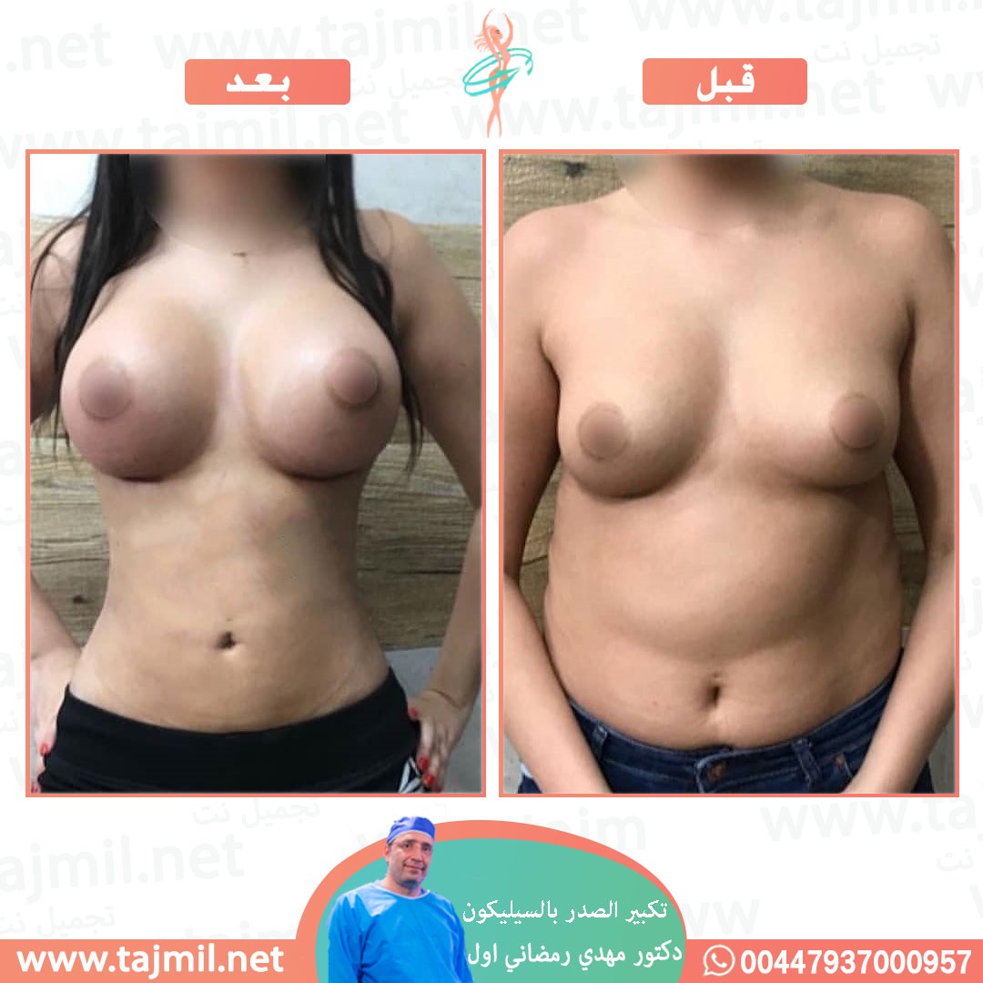  - دكتور مهدي رمضاني اول عملية تکبیر الصدر بالسیلیکون في ايران مع تجميل نت