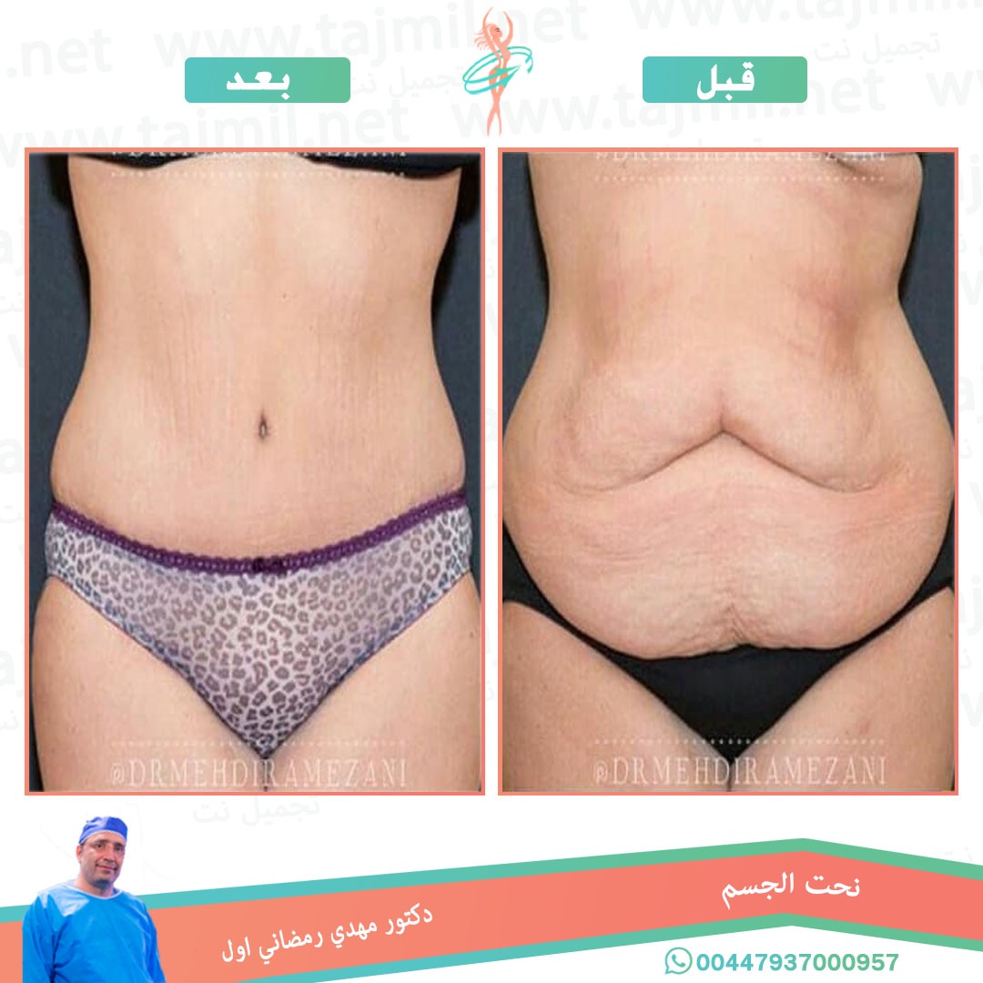  - دكتور مهدي رمضاني اول عملية نحت الجسم في ايران مع تجميل نت