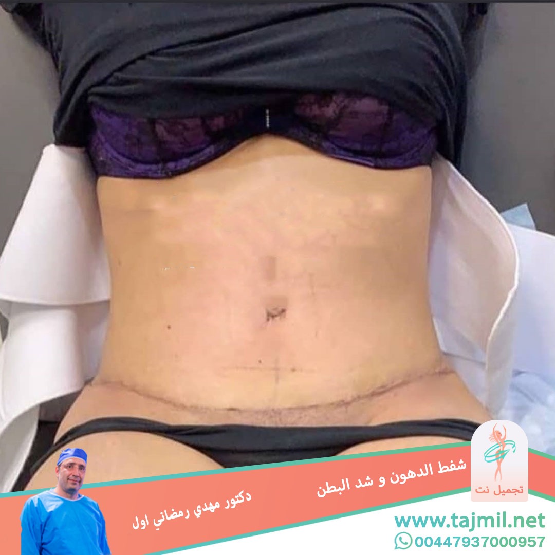  - دكتور مهدي رمضاني اول عملية شفط الدهون  شد البطن في ايران مع تجميل نت