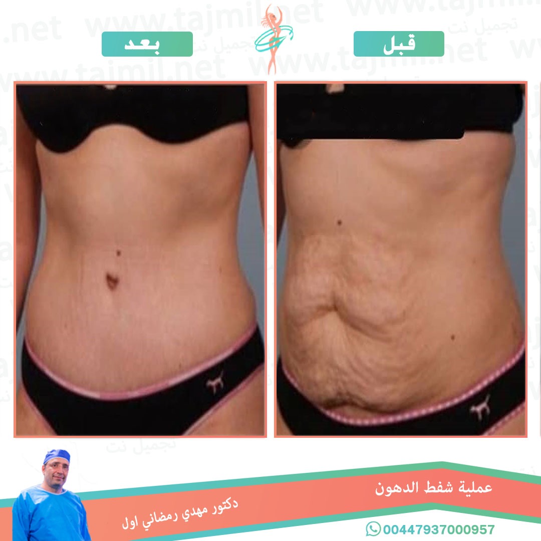  - دكتور مهدي رمضاني اول عملية شفط الدهون في ايران مع تجميل نت