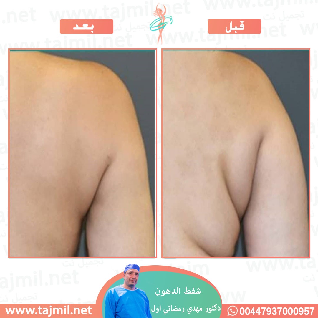  - دکتور إحسان خدیوي عملية شفط الدهون في ايران مع تجميل نت